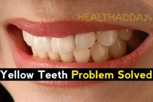 अगर आपके दांत पीले हैं तो आप इसे जरूर पढ़ें। If your teeth are yellow then definitely read this.yellow teeth, yellow teeth whitening products, yellow teeth problem solving, yellow teeth problem solving tricks in hindi