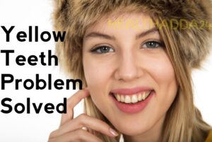 अगर आपके दांत पीले हैं तो आप इसे जरूर पढ़ें। If your teeth are yellow then definitely read this.yellow teeth, yellow teeth whitening products, yellow teeth problem solving, yellow teeth problem solving tricks in hindi